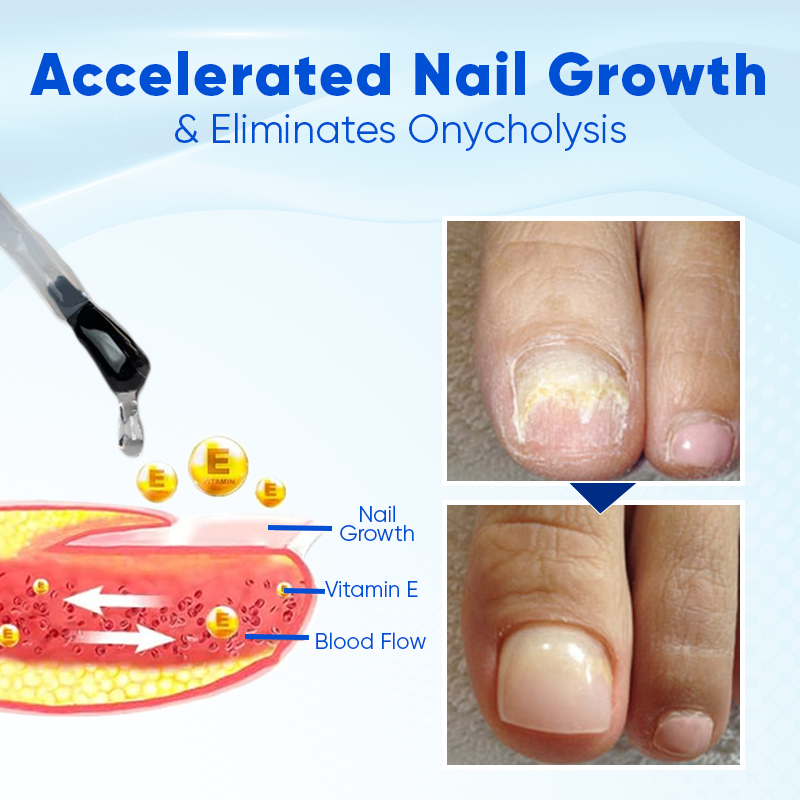 ✨Negusy™ OnyxoGuard: The Ultimate Nail Growth & Repair Serum for Stronger, Healthier Nails💅